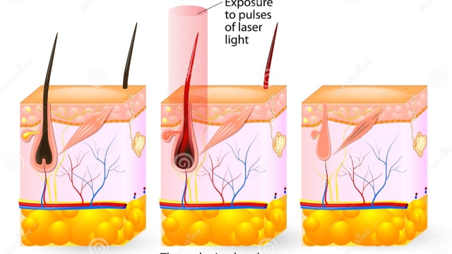 The Smooth Guide: Unraveling the Wonders of Laser Hair Removal