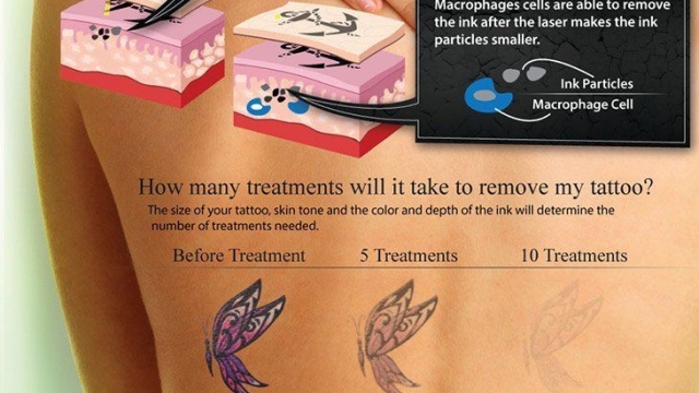 It Will Never Be Fun – Tattoo Removal Pain Management