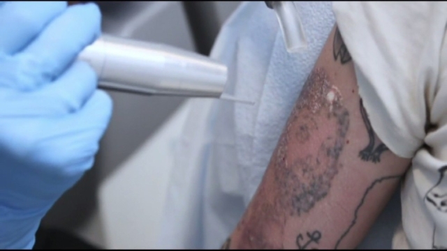 Tca Tattoo Removal – Removing A Tattoo By Your Forearm