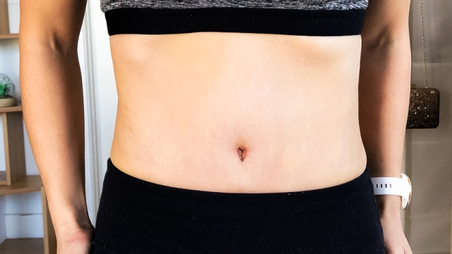 Flat Belly Dreams: The Ultimate Guide to Abdominoplasty