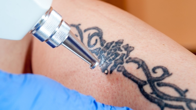 Tattoo Removal Options – What Opt For From?