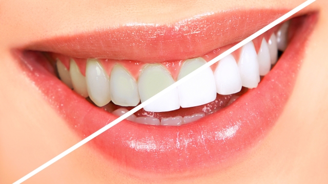 Sparkling Smiles: Unveiling the Secrets to Pearly Whites with Teeth Whitening Products