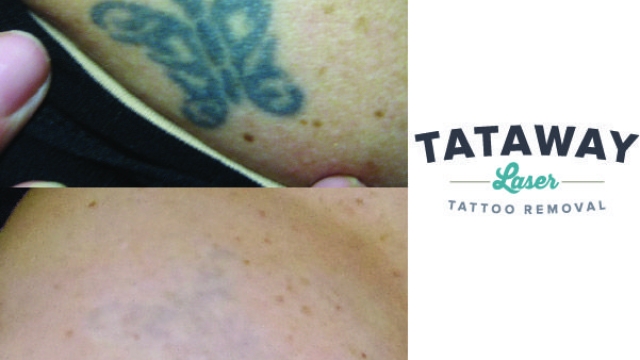 Tattoo Removal Procedure – Your Selection For A Tattoo That Could Be Removed