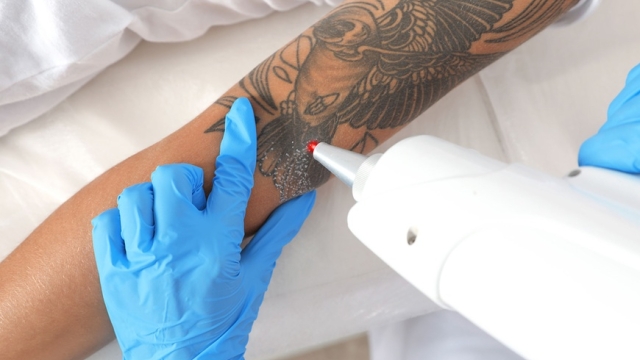 Top 4 Tattoo Removal Programs To Take Into Consideration